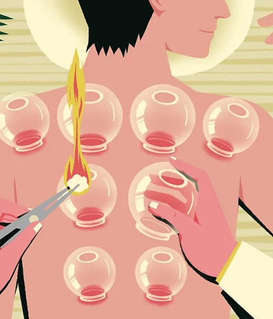 Cupping therapy cups on the back